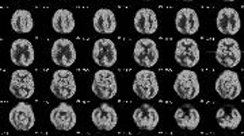 MRI of Alzheimer's disease (Representational Image: Unsplash)