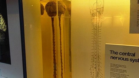 Treat secondary CNS involvement by aggressive lymphomas (Representational Image: Wikimedia Commons)
