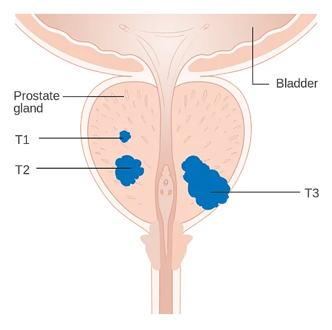 Cancer-causing mutations rewire growth signaling in prostate cancer model (Wikimedia commons)