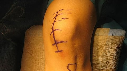 Yet in just three years, the Optetrak implant manufactured by Exactech in Gainesville, Florida, had worn out and had to be replaced — a painful and debilitating operation (Representative Image: Wikimedia Commons)