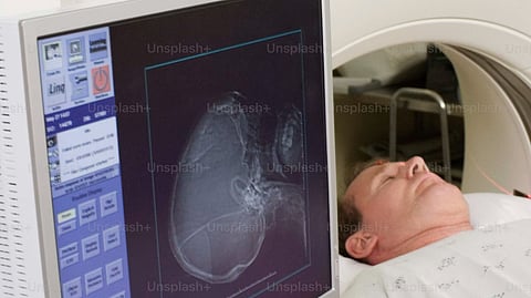 Simple MRI Scan Could Predict Radiation Side Effects for Prostate Cancer (Representational image: Unplash)