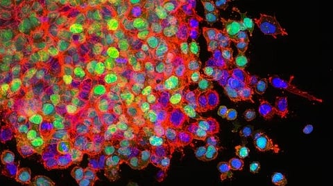 Scientists identify new pathway activated by interferon-gamma that leads to tumor cell death (Representational Image: Unsplash)