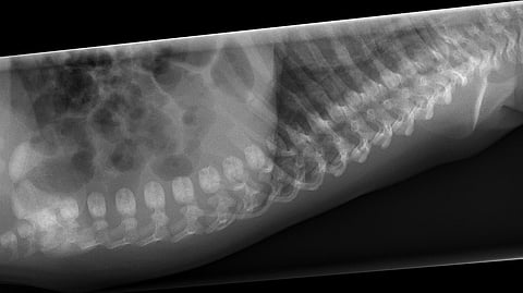Quinn immediately ordered a standing X-ray of Ruth’s entire spine, as well as a full CT scan on her back. The tests and scans showed the complete loss of curvature in her lumbar spine, due to her previous spinal fusions (Representational Image: Wikimedia Commons)