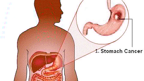 "Pyrvinium is a unique candidate for potential therapeutic prevention of stomach cancer in patients with high-risk precancer,” said Choi (Representational Image: Wikimedia Commons)