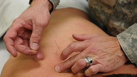 In a previous pilot study, the team found that acupuncture reduced pain and improved quality of life for participants. (Representational image: Wikimedia commons)