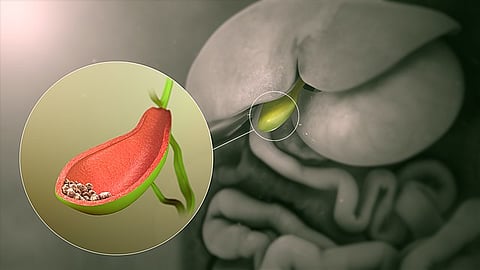 Cholelithiasis is a prevalent hepatobiliary disorder that primarily affects Western populations. It is a significant risk factor for cholangiocarcinoma, a type of bile duct cancer.
(Representational Image: Wikimedia Commons)