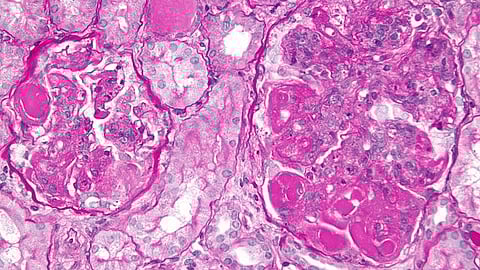 Obinutuzumab—an antibody that targets a protein expressed on certain immune cells in patients with lupus nephritis, a kidney condition associated with the autoimmune disease lupus. (Representational Image: Wikimedia Common)