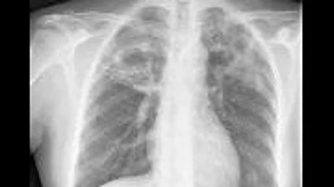 Child tuberculosis is often characterized by a low bacterial load and unspecific symptoms.(Representational image: MedPix)