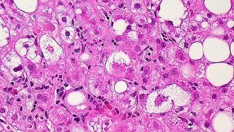 Liver fibrosis may occur as a result of liver diseases such as metabolic dysfunction-associated steatotic liver disease (MASLD) and metabolic dysfunction-associated steatohepatitis (MASH)
(Representational image: Wikimedia Commons)