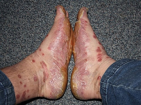 Psoriasis is a chronic immune-mediated inflammatory systemic disease characterized by red and scaly plaques.
(Representational image: Wikimedia Commons)