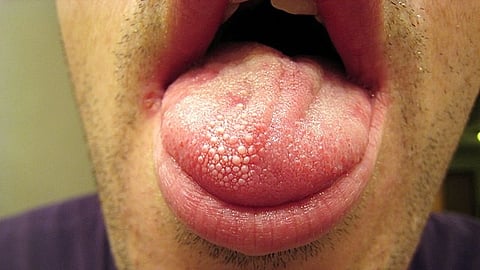 A novel aqueous lubricant technology designed to help people who suffer from a dry mouth. (Representational Image: Wikimedia Common)