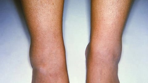 Physical activity is essential for older adults with arthritis, as it can help to reduce pain and stiffness, improve mobility, and maintain independence.
(Representational image: CDC PHIL)