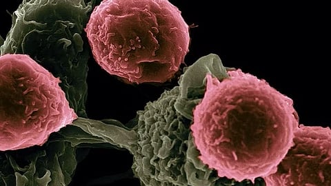 Metabolites called nucleotides are the building blocks of DNA and can impact cancer’s sensitivity or resistance to chemotherapy and radiation in brain cancer.
(Representational Image :Unsplash)