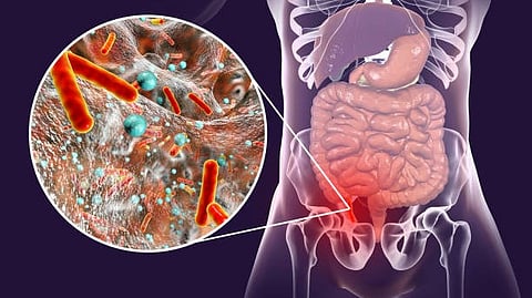 Tissue immunoexpression of IL-6 and IL-18 in aging men with BPH and MetS and their relationship with lipid parameters and gut microbiota-derived short chain fatty acids. (Representational Image: Unsplash)