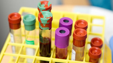 While monitoring a patient for prostate cancer DNA after treatment, the researchers identified genetic material coming, not from prostate cancer, but from a type of cancer that starts in or near the urinary bladder.
(Representational image: Unsplash)