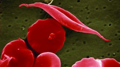 New gene therapies promise a cure for their sickle cell disease. (Representational Image: Wikimedia Commons)
