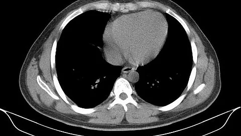 The doctors identified a blackish mass on her left buttock and diagnosed it as flesh-eating bacteria, which is fatal.
(Representational image: Wikimedia Commons)