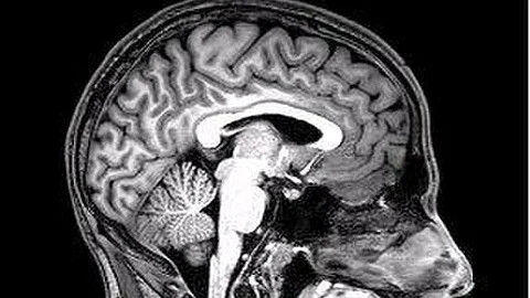 Most studies of neurodegenerative diseases focus on the impact of brain shrinkage, but these conditions are also commonly linked to abnormalities in the brain's white matter – the bundles of nerve fibres that connect different brain regions. (Representational Image: Wikimedia Commons)