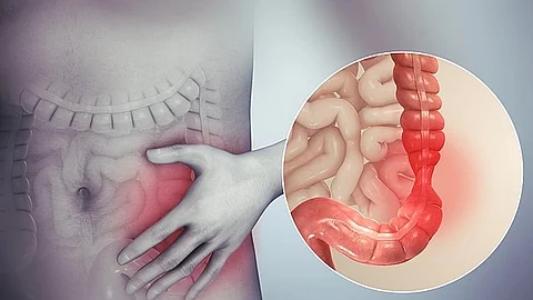 The authors say these molecules could someday serve as a biomarker for diagnosing IBD. (Representational Image: Wikimedia Commons)