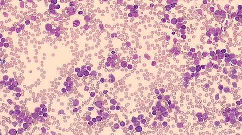 In leukemia patients, the cancer cells’ genetic material has a characteristic mutation that affects the so-called NPM1 gene(Representational image:Wikimedia commons)