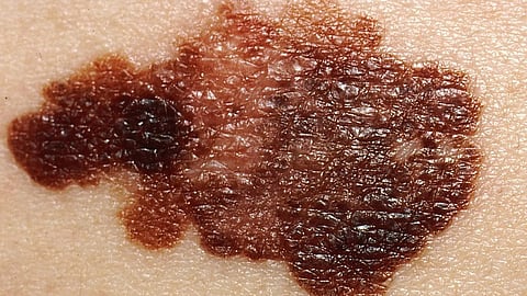 Moffitt Researchers Identify Cell Signaling Pathway Controlling Melanoma Cell Metastasis to the Brain (Representational image: Wikimedia commons)