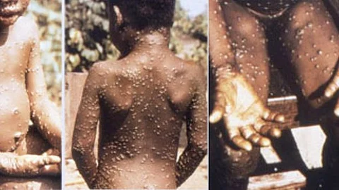 As Congo copes with its biggest outbreak of mpox, scientists warn discrimination against gay and bisexual men on the continent could make it worse. (Representational Image: Wikimedia Commons)