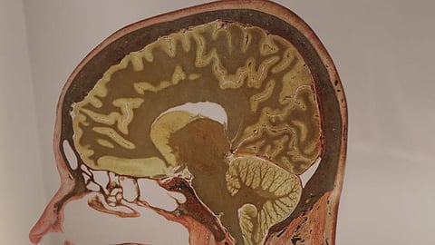 Traumatic brain injuries resulting from head trauma or blast explosions are a leading cause of post-traumatic stress disorder, anxiety, depression and suicide among veterans (Representational image : Wikimedia commons)
