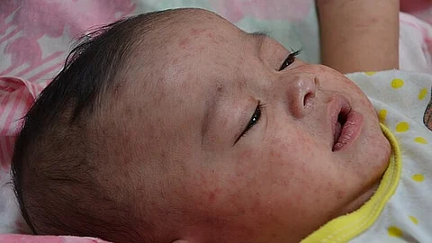 Eight people have been confirmed to have measles in Philadelphia. (Representational Image: Wikimedia Commons)