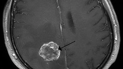 Their research suggests that a small number of pediatric brain tumor patients already have cancer-fighting T cells within their tumors. (Representational Image: Wikimedia Commons)