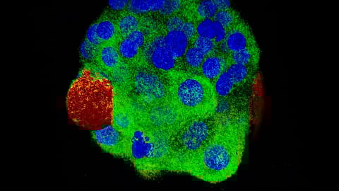 Depending on their location, cancer cells within a three-dimensional (3D) tumor structure can have different microenvironments. (Representational Image: Wikimedia Commons)