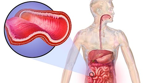 The diagnostic test confirmed she had Crohn’s disease, an autoimmune condition that would require lifelong management. (Representational Image: Wikimedia Commons)