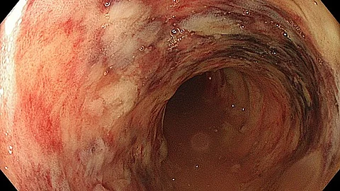 The study, published in Gastro Hep Advances, may assist caregivers and help shed light on how diet, lifestyle and genetics can affect the development and disease course of Inflammatory Bowel Disease (Representational Image Wikimedia Commons)