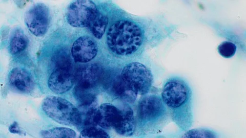 tumor images under a microscope