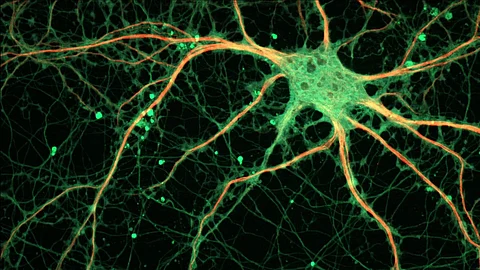 Multiple sclerosis disease occurs when immune system cells mistakenly attack the protective coating on nerve fibers, gradually eroding them (Representational image: Wikimedia commons)