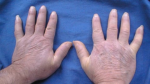 EBV infection has long been associated with multiple sclerosis, but how the infection might contribute to multiple sclerosis has not been clear. (Representational Image: Wikimedia Commons)