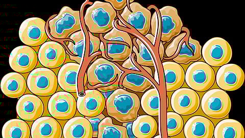 Cancer dissemination (Wikimedia Commons)