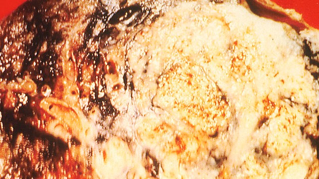 A specific combination of targeted therapy and immunotherapy may better help patients with non-small cell lung cancer (NSCLC) overcome inherent immune resistance and reinvigorate anti-tumor activity (Wikimedia Commons)