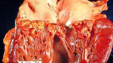 Gross pathology of subacute bacterial endocarditis involving the mitral valve of the heart (Representational Image: Wikimedia Commons)