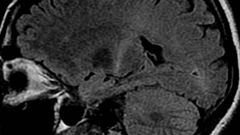 ALS is a degenerative disease of the nervous system particularly affecting and harmful to motor neurons. (Representational image: Wikimedia Commons)