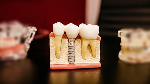 Dentures and dental implants are the currently available treatment options for replacement of missing teeth (Representational image: Wikimedia Commons)