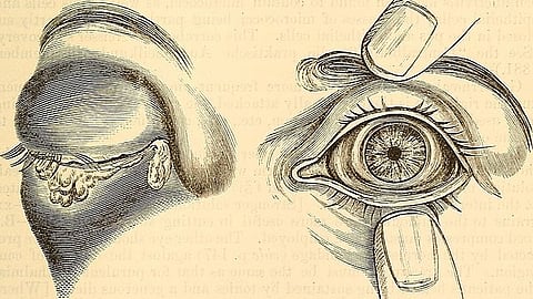 Schematic representation of eye infections- Papillae are much swollen and very prominent, like cauliflower excrescences (Wikimedia Commons)