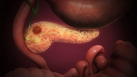 Metastatic spread is one of the reasons pancreatic cancer is such a deadly disease. (Representational image: Wikimedia commons)