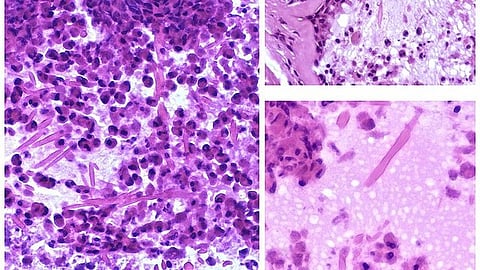 Mysteries in Chronic Rhinosinusitis (Representational image: Wikimedia Commons)