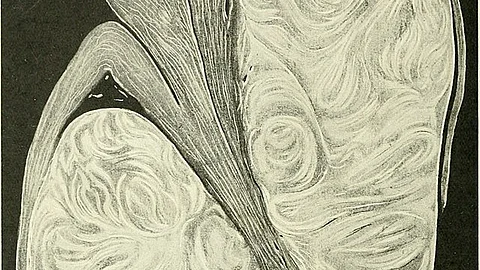 The surgery, which was highlighted for its unique approach, involved a Pfannenstiel incision. This is typically used in caesarean sections. (Representational Image: Wikimedia Commons)