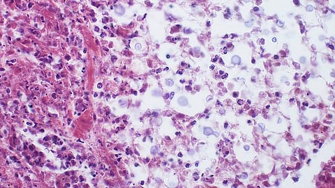 Cryptococcosis is a fungal infection of mainly the lungs that might lead to meningitis. (Representational Image: Wikimedia commons)