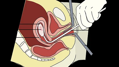 A diagram of a vacuum aspiration abortion procedure at 8 weeks gestation. (Wikimedia Commons)