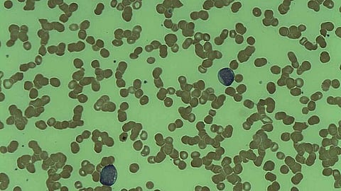 Acute Myeloid Leukemia (Wikimedia commons)