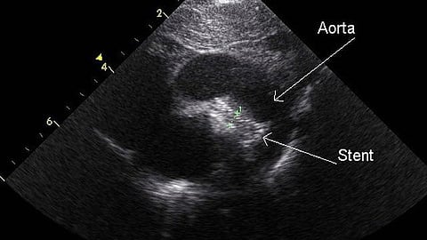 Intravascular imaging guidance improves survival and enhances all aspects of the safety and effectiveness of coronary stenting.(Representational Image: Wikimedia Commons)