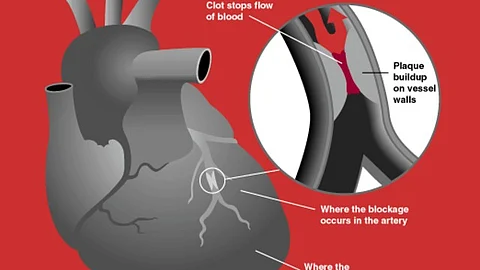 Using the results of a standard blood test and an online tool, you can find out if you are at increased risk of having a heart attack within six months. (Representational Image: Wikimedia Commons)