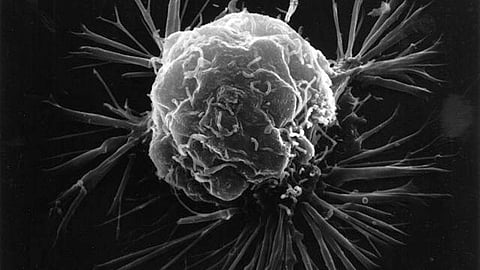 Electron microscopic view of cancer cell (Wikimedia Commons)
